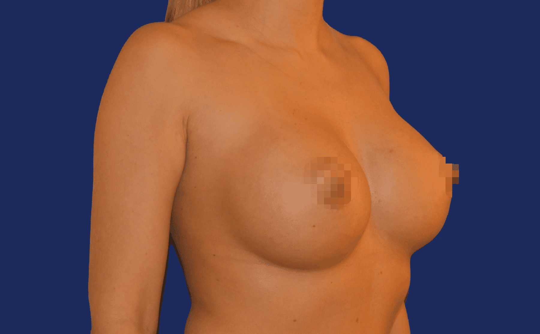 Endoskopische Brustvergrößerung